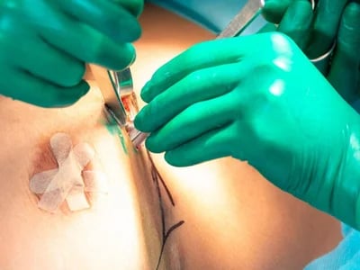 Brustvergrößerung mit Eigenfett: Natürlichkeit trifft auf moderne Chirurgie