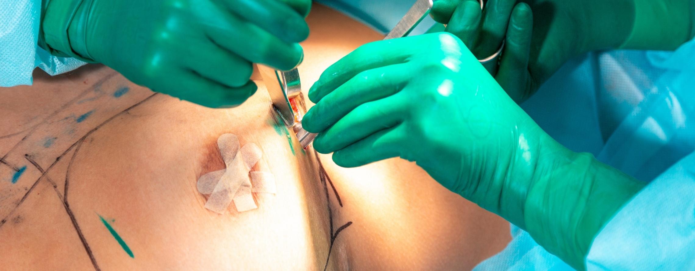 Brustvergrößerung mit Eigenfett: Natürlichkeit trifft auf moderne Chirurgie