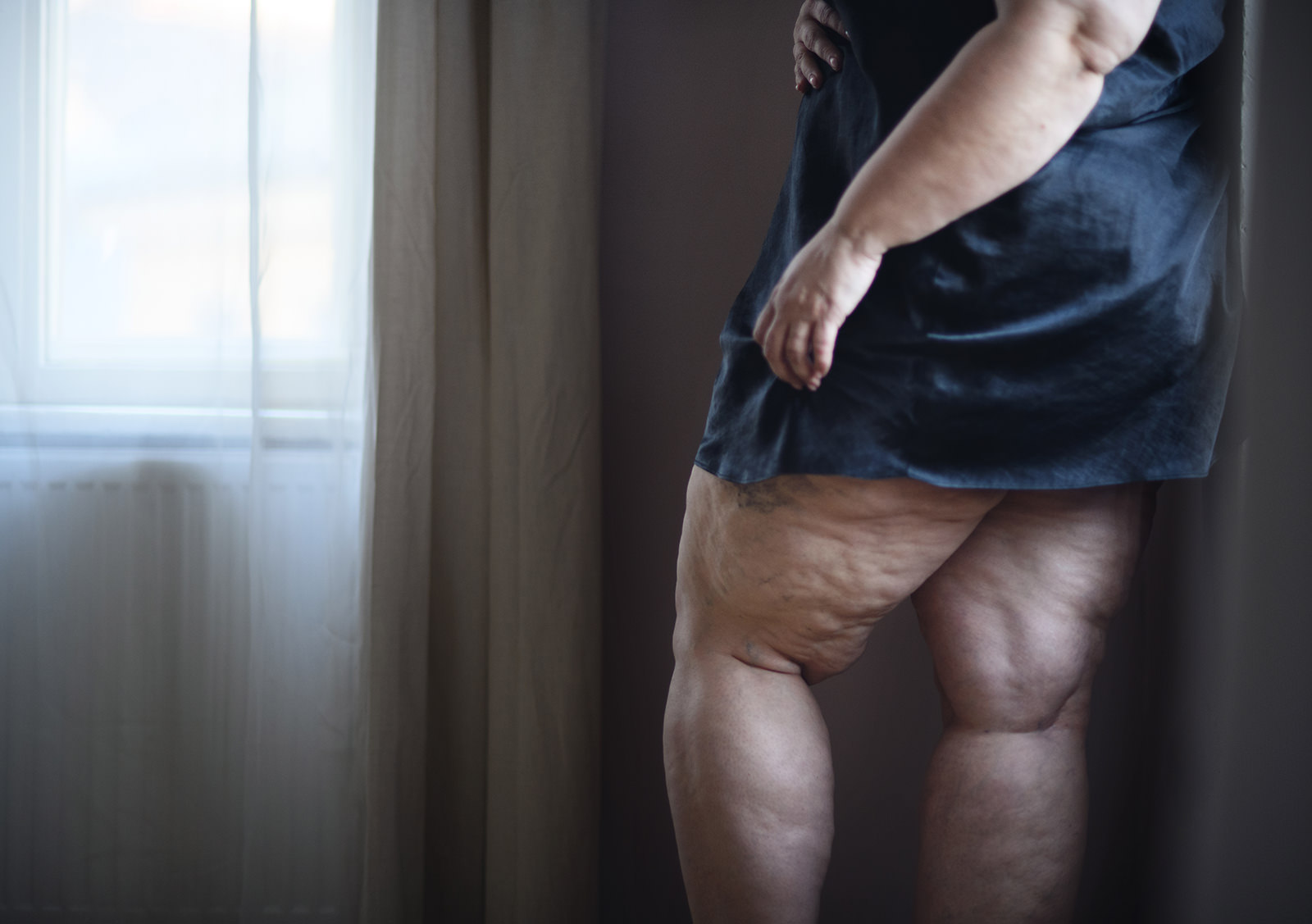 Lipödem erkennen: Der Einfluss von Lebensstil und hormonellen Veränderungen